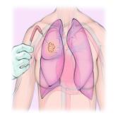 Ablation ضایعات ریوی