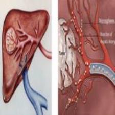 ماکروویو تومور های کبدی