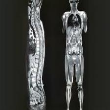 Whole body MRI