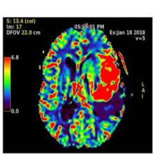 MR Perfusion مغز