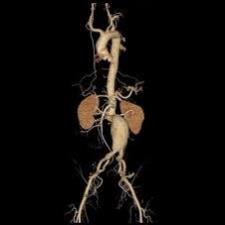 سی تی آنژیو آئورت توراسیك و شكمی