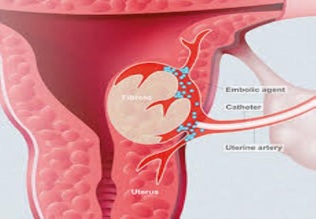 Uterine Fibroid Embolization