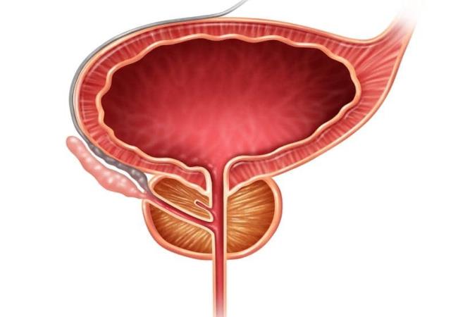 Prostate Artery Embolization