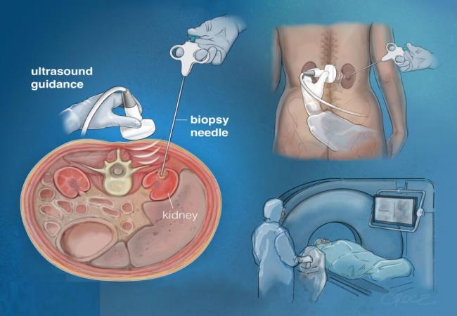 Biopsy Procedures