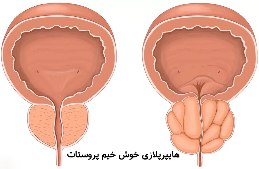 هایپرپلازی خوش خیم پروستات؛ علت ها و نحوه تشخیص